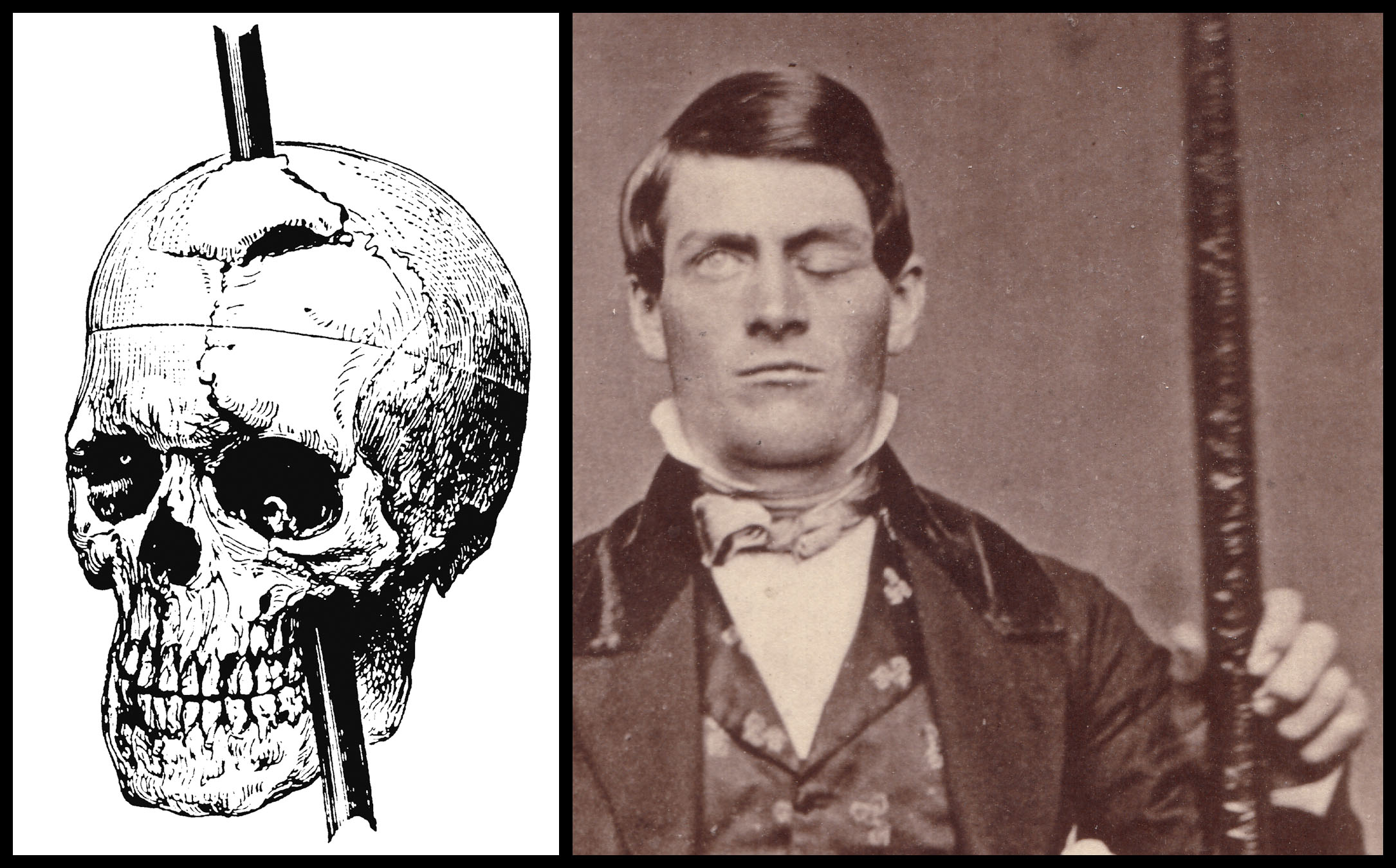 Phineas Gage Un Caso Storico In Campo Neurologico Esperienziando Vitae Phineas Gage Un Caso Storico In Campo Neurologico Esperienziando Vitae