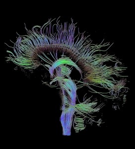 Ricostruzione trattografica delle connessioni neurali ottenuta con la tecnica di imaging a spettro di diffusione